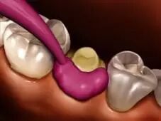 牙科材料硅胶怎么用硅橡胶临床操作指南_https://www.jmylbn.com_新闻资讯_第4张