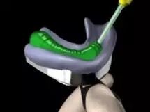 牙科材料硅胶怎么用硅橡胶临床操作指南_https://www.jmylbn.com_新闻资讯_第8张