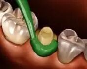 牙科材料硅胶怎么用硅橡胶临床操作指南_https://www.jmylbn.com_新闻资讯_第9张