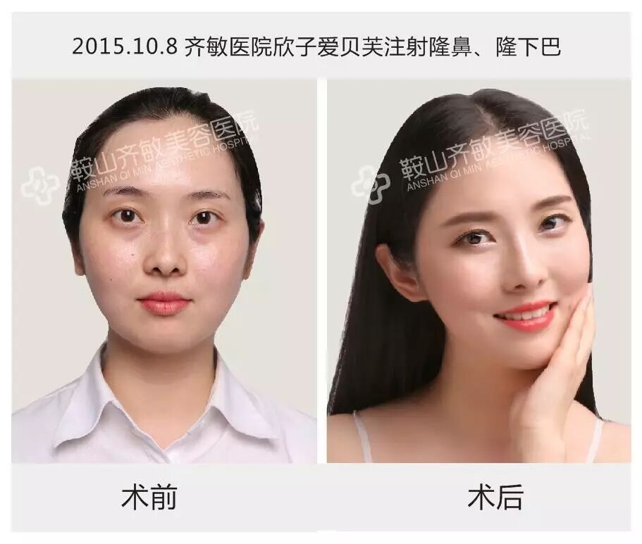 爱贝芙隆鼻,隆下巴