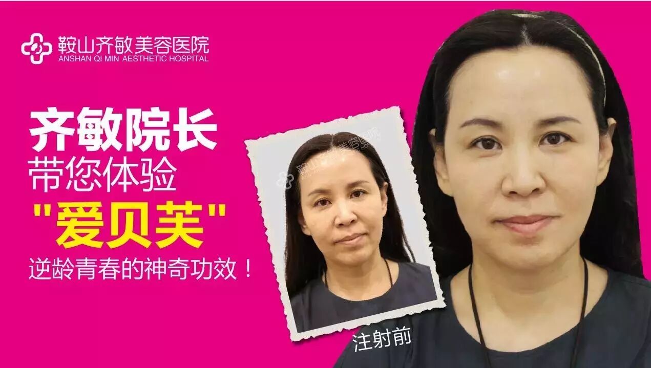 【齐敏真实案例】齐敏院长和马晓玲总监带您体验"爱贝芙"注射的逆龄之
