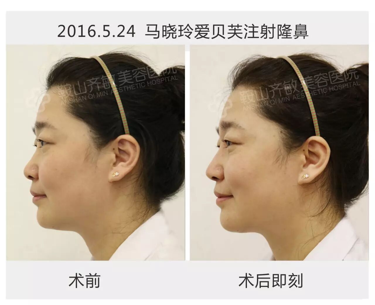 【齐敏真实案例】齐敏院长和马晓玲总监带您体验"爱贝芙"注射的逆龄之