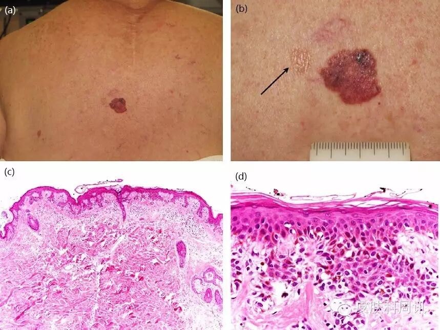 综述有特殊特征的黑素细胞痣临床皮肤镜和反射式共聚焦显微镜表现3