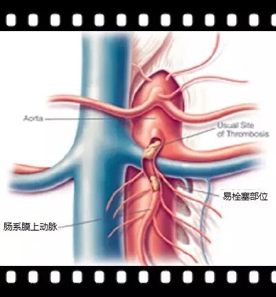 肠系膜动脉四肢血管(下肢动脉多见且严重)肾动脉(好发于肾动脉开口处