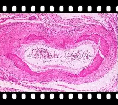 2.进展病变-1:纤维斑块(是由脂纹发展而来)(一)不同时期的斑块1.