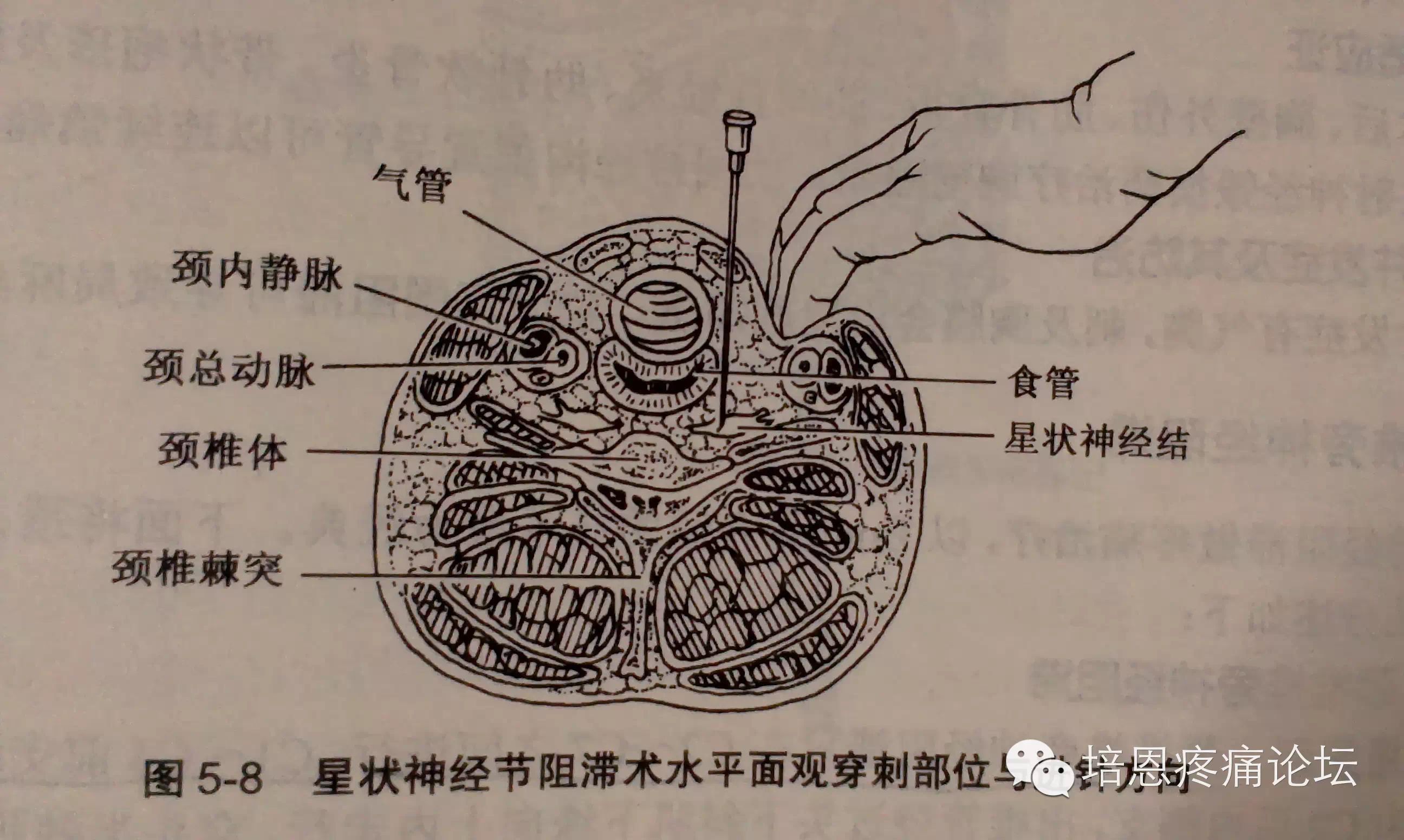 星状神经节阻滞疗法抗焦虑治失眠疼痛效果好
