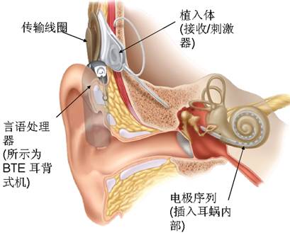助听器和人工耳蜗的区别