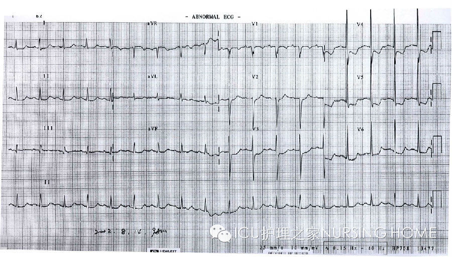 icu实用心电图下