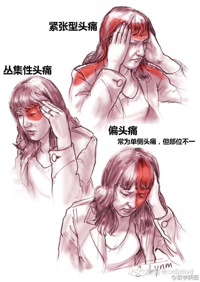 不同位置头痛起因不同