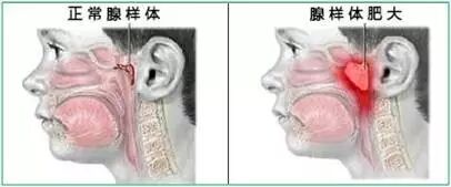【鼻炎·养护】小儿腺样体肥大