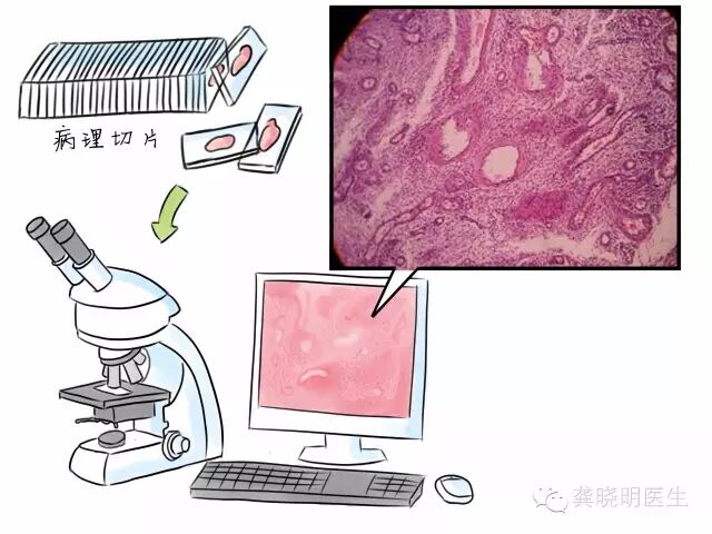 绝经后又出血,难道是失散多年的月经又来啦?