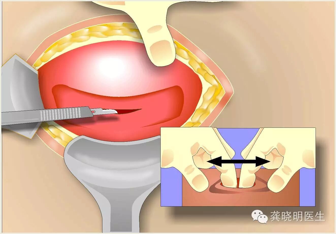 之后有出现阴道助产,就是采用胎儿吸引器或者产钳辅助孩子出来,再后来