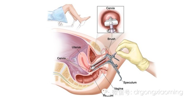 最近临床工作中已经连续遇到几例宫颈刮片检查正常,在短期内又发现