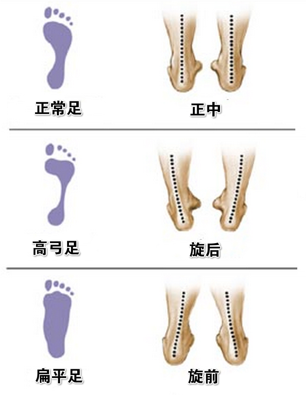 正常的内侧足弓的角度为125度,大于这个角度,称为扁平足,小于这个角度