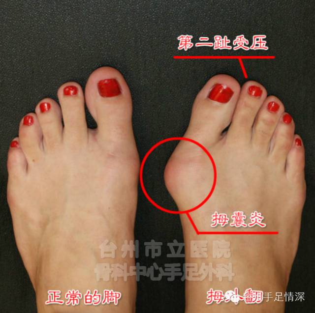 3.前脚掌出现老茧(胼胝,行走疼痛