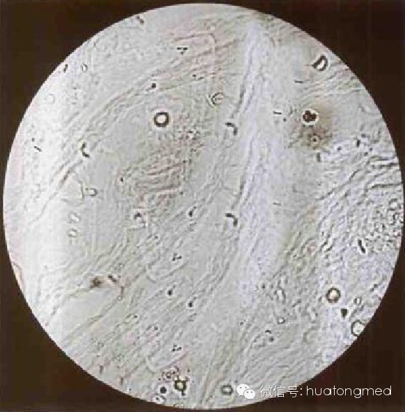 粘液丝肾小管上皮细胞管型细菌管型肾衰竭管型又称宽管型脂肪管型蜡样