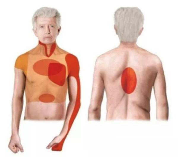 心绞痛那些不为人知的秘密