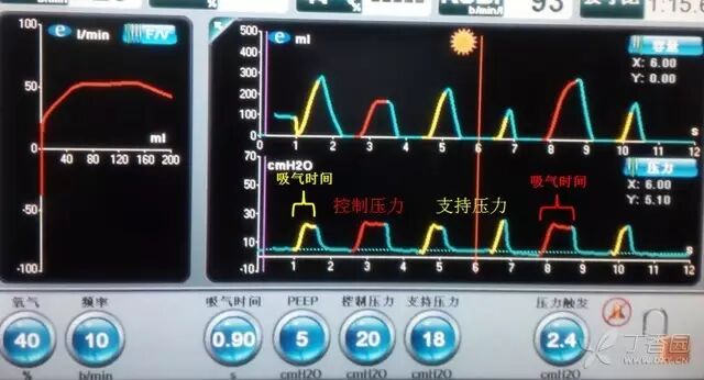 呼吸机是怎么给压力的呼吸机菜鸟上手指南：机械通气参数设置不再傻傻搞不清_https://www.jmylbn.com_新闻资讯_第5张