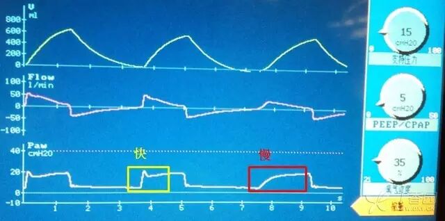 呼吸机是怎么给压力的呼吸机菜鸟上手指南：机械通气参数设置不再傻傻搞不清_https://www.jmylbn.com_新闻资讯_第3张