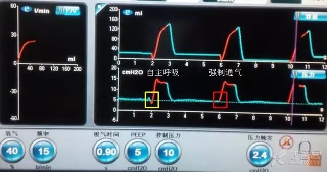 呼吸机是怎么给压力的呼吸机菜鸟上手指南：机械通气参数设置不再傻傻搞不清_https://www.jmylbn.com_新闻资讯_第1张