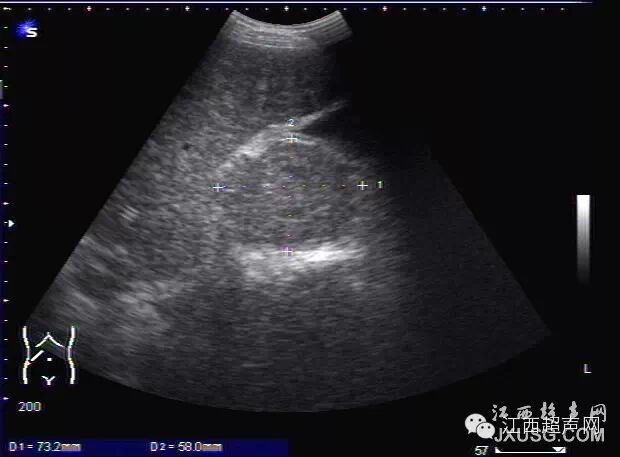 彩超伪像是什么60个超声诊断中容易误诊的正常结构_https://www.jmylbn.com_新闻资讯_第3张