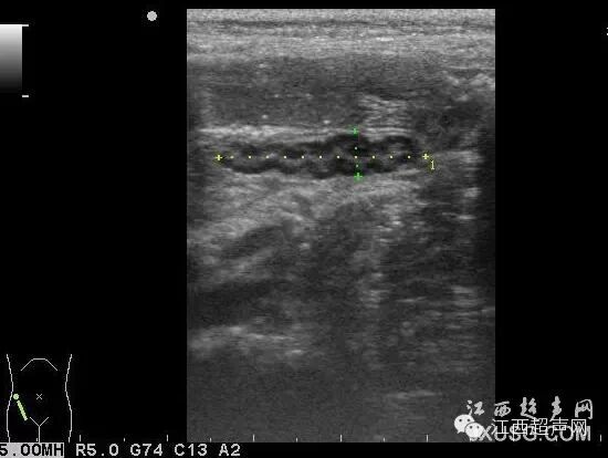 彩超伪像是什么60个超声诊断中容易误诊的正常结构_https://www.jmylbn.com_新闻资讯_第13张
