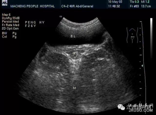 彩超伪像是什么60个超声诊断中容易误诊的正常结构_https://www.jmylbn.com_新闻资讯_第6张