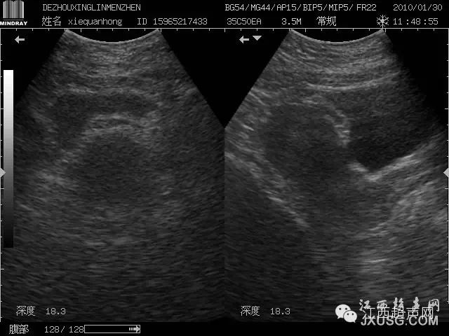 彩超伪像是什么60个超声诊断中容易误诊的正常结构_https://www.jmylbn.com_新闻资讯_第10张