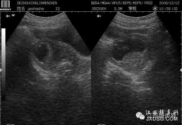 彩超伪像是什么60个超声诊断中容易误诊的正常结构_https://www.jmylbn.com_新闻资讯_第7张