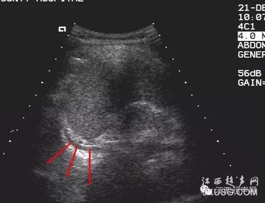 彩超伪像是什么60个超声诊断中容易误诊的正常结构_https://www.jmylbn.com_新闻资讯_第5张
