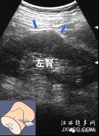 彩超伪像是什么60个超声诊断中容易误诊的正常结构_https://www.jmylbn.com_新闻资讯_第9张