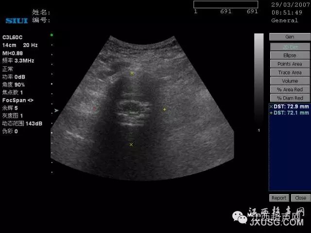 彩超伪像是什么60个超声诊断中容易误诊的正常结构_https://www.jmylbn.com_新闻资讯_第4张