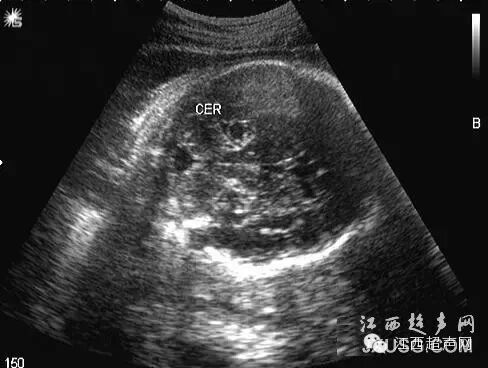 彩超伪像是什么60个超声诊断中容易误诊的正常结构_https://www.jmylbn.com_新闻资讯_第14张