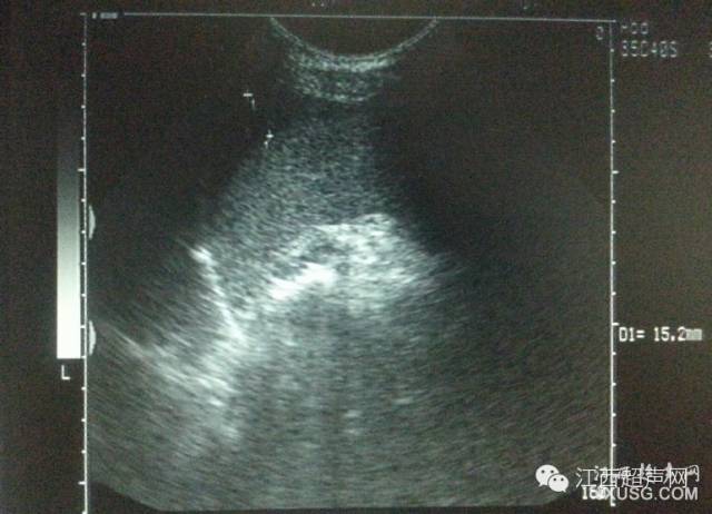 彩超伪像是什么60个超声诊断中容易误诊的正常结构_https://www.jmylbn.com_新闻资讯_第12张
