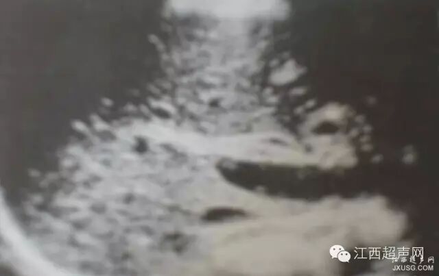 彩超伪像是什么60个超声诊断中容易误诊的正常结构_https://www.jmylbn.com_新闻资讯_第8张