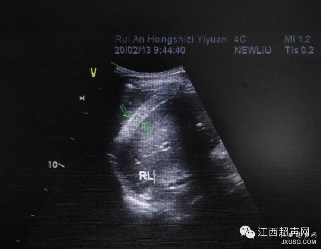 彩超伪像是什么60个超声诊断中容易误诊的正常结构_https://www.jmylbn.com_新闻资讯_第11张
