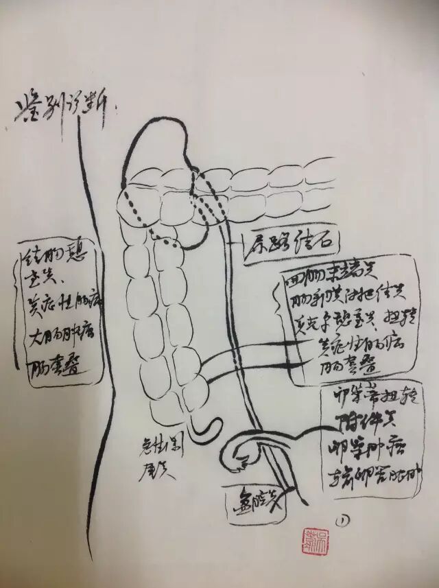 阑尾切除手绘如果术中发现为盲肠肿瘤,最好另外切口行根治性手术,行多