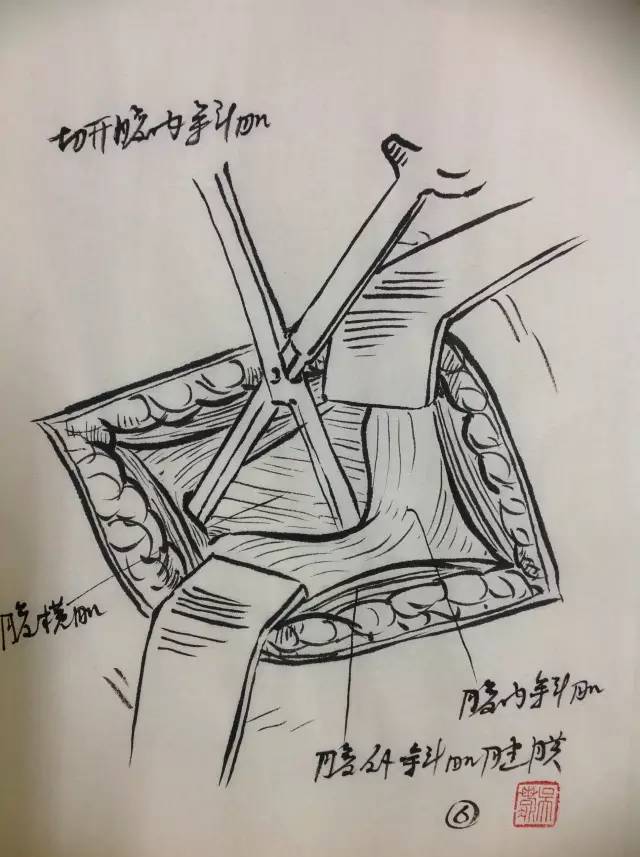 kocher切口解剖层次图片