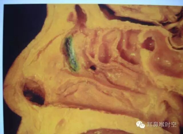 操作鼻窦镜时怎么摆基础必备 丨 鼻内镜鼻窦手术的操作过程详解_https://www.jmylbn.com_新闻资讯_第15张