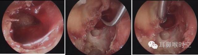 操作鼻窦镜时怎么摆基础必备 丨 鼻内镜鼻窦手术的操作过程详解_https://www.jmylbn.com_新闻资讯_第13张