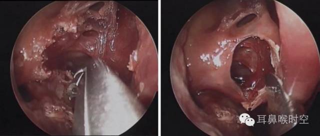 操作鼻窦镜时怎么摆基础必备 丨 鼻内镜鼻窦手术的操作过程详解_https://www.jmylbn.com_新闻资讯_第9张