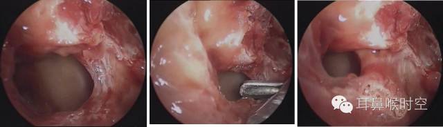 操作鼻窦镜时怎么摆基础必备 丨 鼻内镜鼻窦手术的操作过程详解_https://www.jmylbn.com_新闻资讯_第10张