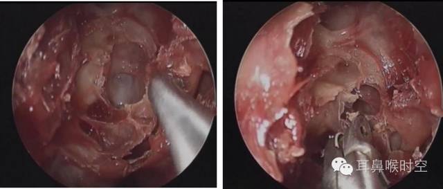 操作鼻窦镜时怎么摆基础必备 丨 鼻内镜鼻窦手术的操作过程详解_https://www.jmylbn.com_新闻资讯_第11张