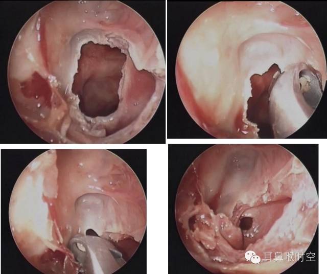 操作鼻窦镜时怎么摆基础必备 丨 鼻内镜鼻窦手术的操作过程详解_https://www.jmylbn.com_新闻资讯_第12张
