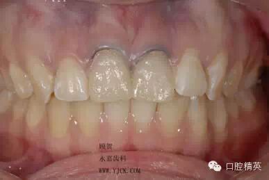 dmg口腔材料怎么使用不要小看临时牙_https://www.jmylbn.com_新闻资讯_第14张