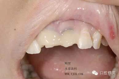 dmg口腔材料怎么使用不要小看临时牙_https://www.jmylbn.com_新闻资讯_第12张