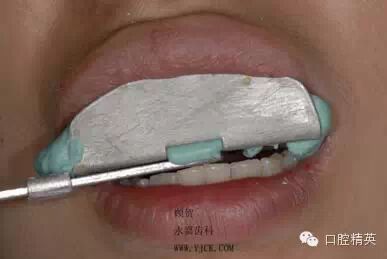 dmg口腔材料怎么使用不要小看临时牙_https://www.jmylbn.com_新闻资讯_第6张