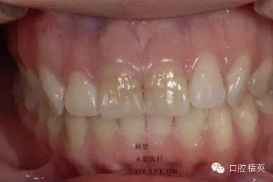 dmg口腔材料怎么使用不要小看临时牙_https://www.jmylbn.com_新闻资讯_第5张