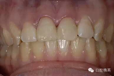 dmg口腔材料怎么使用不要小看临时牙_https://www.jmylbn.com_新闻资讯_第15张