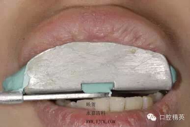 dmg口腔材料怎么使用不要小看临时牙_https://www.jmylbn.com_新闻资讯_第13张